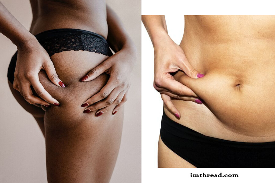 Various Treatments For Cellulite 