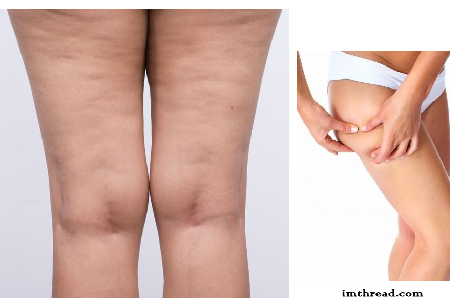 Various Treatments For Cellulite 